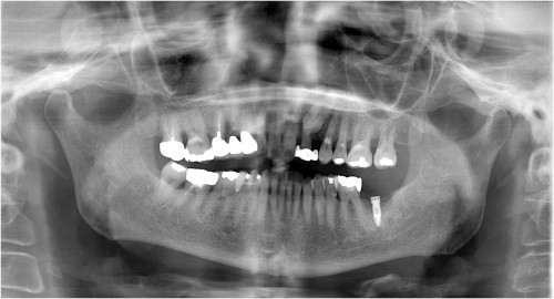 平田6　埋入時・抜歯後4ヶ月半